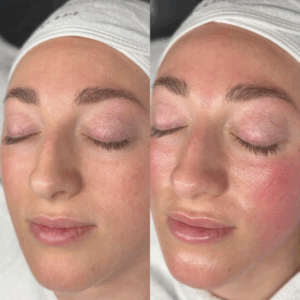 Aquafacial-Vorher-Nachher