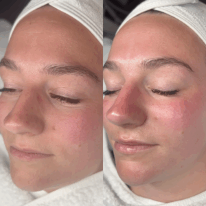 Aquafacial-Vorher-Nachher